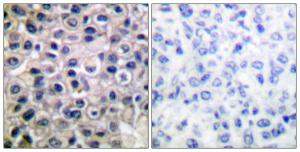 Immunohistochemical analysis of paraffin-embedded human breast carcinoma tissue using Anti-MMP-14 Antibody. The right hand panel represents a negative control, where the antibody was pre-incubated with the immunising peptide