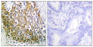 Immunohistochemical analysis of paraffin-embedded human lung carcinoma tissue using Anti-MMP-10 Antibody. The right hand panel represents a negative control, where the antibody was pre-incubated with the immunising peptide