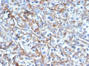 Immunohistochemical analysis of formalin-fixed, paraffin-embedded human renal cell carcinoma using Anti-ICAM1 Antibody [P2A4]