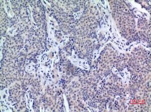 Immunohistochemical analysis of paraffin-embedded human mammary cancer using Anti-PDGFD Antibody