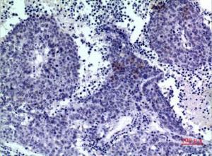 Immunohistochemical analysis of paraffin-embedded human lung cancer using Anti-PDGFD Antibody