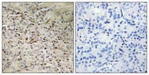 Immunohistochemical analysis of paraffin-embedded human prostate cancer using Anti-PBOV1 Antibody 1:100 (4°C overnight) The right hand panel represents a negative control, where the antibody was pre-incubated with the immunising peptide