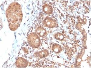 Immunohistochemical analysis of formalin-fixed, paraffin-embedded human colon carcinoma tissue using Anti-IL-3 Antibody [IL3/4004]