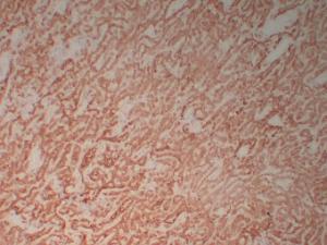 Immunohistochemical analysis of paraffin-embedded human Mesothelioma using Anti-Calretinin Antibody