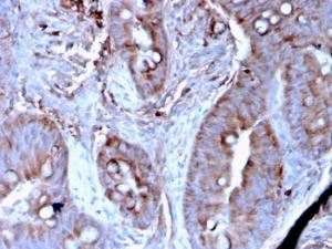 Immunohistochemical analysis of formalin-fixed, paraffin-embedded human colon carcinoma tissue using Anti-MerTK Antibody [MERTK/3024]