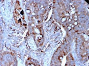 Immunohistochemical analysis of formalin-fixed, paraffin-embedded human colon carcinoma tissue using Anti-MerTK Antibody [MERTK/3024]