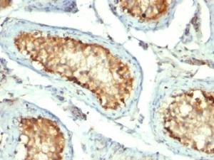 Immunohistochemical analysis of formalin-fixed, paraffin-embedded human testicular carcinoma using Anti-HSP60 Antibody [GROEL/730]