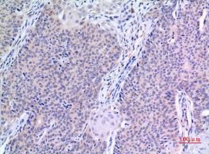 Immunohistochemical analysis of paraffin-embedded human mammary cancer using Anti-VGF Antibody