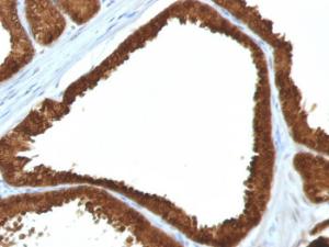 Immunohistochemical analysis of formalin-fixed, paraffin-embedded human colon carcinoma using Anti-IDH1 Antibody [IDH1/1152]