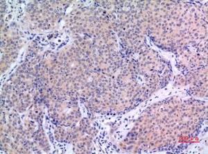 Immunohistochemical analysis of paraffin-embedded human mammary cancer using Anti-VGF Antibody