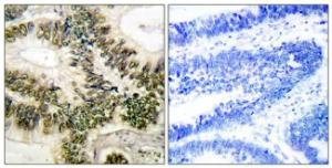 Immunohistochemical analysis of paraffin-embedded human colon carcinoma tissue using Anti-Cyclin E1 Antibody. The right hand panel represents a negative control, where the antibody was pre-incubated with the immunising peptide