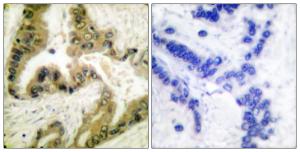 Immunohistochemical analysis of paraffin-embedded human lung carcinoma tissue using Anti-HDAC10 Antibody. The right hand panel represents a negative control, where the antibody was pre-incubated with the immunising peptide