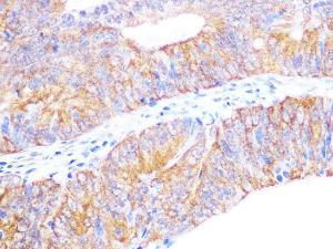 Immunohistochemistry analysis of paraffin-embedded human colon carcinoma tissue using Anti-Cyclophilin 40 Antibody [ARC1260] (A306261) at a dilution of 1:100 (40x lens). Perform microwave antigen retrieval with 10 mM PBS buffer pH 7.2 before commencing with IHC staining protocol.