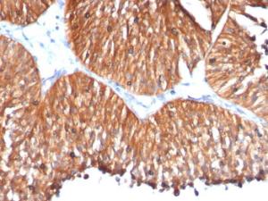 Immunohistochemical analysis of formalin-fixed, paraffin-embedded human bladder carcinoma using Anti-HSP60 Antibody [HSPD1/780]