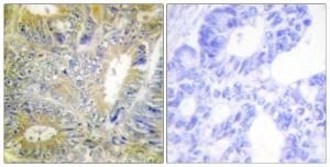 Immunohistochemical analysis of paraffin-embedded human colon carcinoma tissue using Anti-Desmin Antibody. The right hand panel represents a negative control, where the antibody was pre-incubated with the immunising peptide