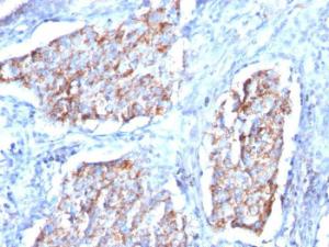 Immunohistochemical analysis of formalin-fixed, paraffin-embedded human lung carcinoma using Anti-HSP60 Antibody [HSPD1/780]