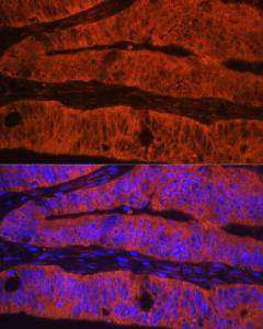 Immunofluorescence analysis of human colon carcinoma using Anti-Talin 1 Antibody (A9389) at a dilution of 1:100. DAPI was used to stain the cell nuclei (blue)