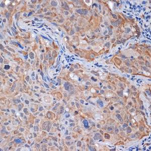 Immunohistochemistry analysis of paraffin-embedded human lung cancer using Anti-PP2A-alpha + PPP2CB Antibody [ARC1889] (A309172) at a dilution of 1:100 (40x lens) Perform microwave antigen retrieval with 10 mM Tris/EDTA buffer pH 90 before commencing with IHC staining protocol