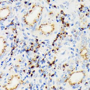 Immunohistochemistry analysis of paraffin-embedded human thyroid cancer using Anti-eIF2A Antibody [ARC1712] (A305361) at a dilution of 1:100 (40x lens) Perform microwave antigen retrieval with 10 mM Tris/EDTA buffer pH 90 before commencing with IHC staining protocol