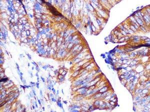 Immunohistochemistry analysis of paraffin-embedded human colon carcinoma tissue using Anti-PAR2 Antibody [ARC1246] (A306265) at a dilution of 1:100 (40X lens). Perform microwave antigen retrieval with 10 mM PBS buffer pH 7.2 before commencing with IHC staining protocol