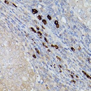 Immunohistochemistry analysis of paraffin-embedded human breast cancer tissue using Anti-Ube2L6 Antibody (A9425) at a dilution of 1:200 (40X lens). Perform microwave antigen retrieval with 10 mM PBS buffer pH 7.2 before commencing with IHC staining protocol