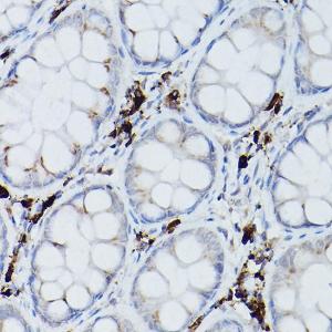 Immunohistochemistry analysis of paraffin-embedded human colon carcinoma tissue using Anti-Ube2L6 Antibody (A9425) at a dilution of 1:200 (40X lens). Perform microwave antigen retrieval with 10 mM PBS buffer pH 7.2 before commencing with IHC staining protocol