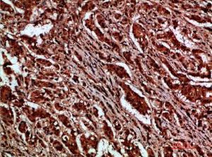 Immunohistochemical analysis of paraffin-embedded human breast cancer using Anti-CTNND1 Antibody