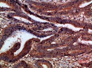 Immunohistochemical analysis of paraffin-embedded human colon cancer using Anti-CTNND1 Antibody