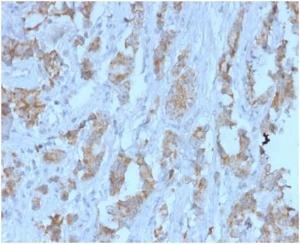 Immunohistochemical analysis of formalin-fixed, paraffin-embedded human ovarian carcinoma tissue using Anti-TDRKH Antibody [PCRP-TDRKH-1H2] at 2 µg/ml