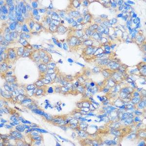 Immunohistochemistry analysis of paraffin-embedded human colon carcinoma tissue using Anti-Pebp4 Antibody (A93291) at a dilution of 1:100 (40x lens). Perform microwave antigen retrieval with 10 mM PBS buffer pH 7.2 before commencing with IHC staining protocol.