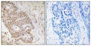 Immunohistochemical analysis of paraffin-embedded human colon carcinoma tissue using Anti-ZNF592 Antibody. The right hand panel represents a negative control, where the antibody was pre-incubated with the immunising peptide.