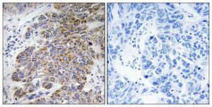 Immunohistochemical analysis of paraffin-embedded human lung carcinoma tissue using Anti-CHST10 Antibody. The right hand panel represents a negative control, where the antibody was pre-incubated with the immunising peptide.