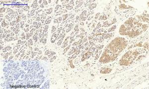 Immunohistochemical analysis of paraffin-embedded human stomach cancer tissue using Anti-VEGFR2 Antibody at 1:200 (4°C overnight). Negative control was secondary antibody only.