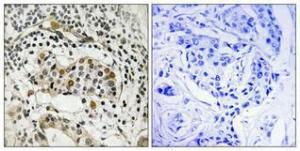 Immunohistochemical analysis of paraffin-embedded human breast cancer using Anti-HBP1 (phospho Ser402) Antibody 1:100 (4°C overnight). The right hand panel represents a negative control, where the antibody was pre-incubated with the immunising peptide.