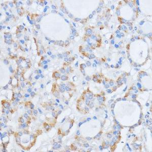 Immunohistochemistry analysis of paraffin-embedded human thyroid cancer using Anti-RALGDS Antibody (A93309) at a dilution of 1:100 (40X lens). Perform microwave antigen retrieval with 10 mM PBS buffer pH 7.2 before commencing with IHC staining protocol