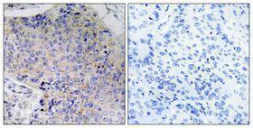 Immunohistochemical analysis of paraffin-embedded human lung cancer using Anti-Tau Antibody 1:100 (4 °C overnight). The right hand panel represents a negative control, where the antibody was pre-incubated with the immunising peptide