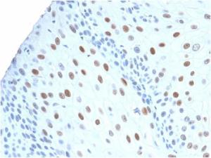 Immunohistochemical analysis of formalin-fixed, paraffin-embedded human urothelial carcinoma using Anti-p21 Antibody [CIP1/2275R]