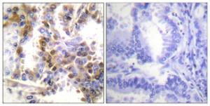 Immunohistochemical analysis of paraffin-embedded human lung carcinoma tissue using Anti-4E-BP1 Antibody The right hand panel represents a negative control, where the antibody was pre-incubated with the immunising peptide