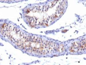 Immunohistochemical analysis of formalin-fixed, paraffin-embedded human testicular carcinoma using Anti-Prolactin Receptor Antibody [PRLR/742]