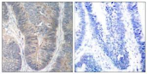 Immunohistochemical analysis of paraffin-embedded human colon carcinoma using Anti-PKR (phospho Thr451) Antibody. The right hand panel represents a negative control, where the antibody was pre-incubated with the immunising peptide