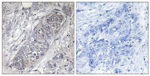 Immunohistochemical analysis of paraffin-embedded human breast carcinoma tissue using Anti-4E-BP1 Antibody. The right hand panel represents a negative control, where the Antibody was pre-incubated with the immunising peptide