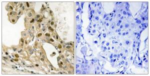 Immunohistochemical analysis of paraffin-embedded human breast carcinoma using Anti-p53 (phospho Thr387) Antibody. The right hand panel represents a negative control, where the antibody was pre-incubated with the immunising peptide.