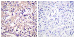 Immunohistochemical analysis of paraffin-embedded human breast carcinoma tissue using Anti-TK Antibody. The right hand panel represents a negative control, where the antibody was pre-incubated with the immunising peptide