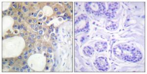 Immunohistochemical analysis of paraffin-embedded human breast carcinoma tissue using Anti-CD227 Antibody. The right hand panel represents a negative control, where the antibody was pre-incubated with the immunising peptide.