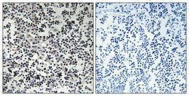 Immunohistochemical analysis of paraffin-embedded human lung cancer using Anti-TK Antibody 1:100 (4 °C overnight). The right hand panel represents a negative control, where the antibody was pre-incubated with the immunising peptide