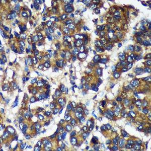 Immunohistochemistry analysis of paraffin-embedded human liver cancer using Anti-TMX2 Antibody (A93341) at a dilution of 1:100 (40x lens). Perform microwave antigen retrieval with 10 mM Tris/EDTA buffer pH 9.0 before commencing with IHC staining protocol.