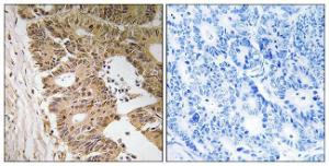 Immunohistochemical analysis of paraffin-embedded human colon carcinoma tissue using Anti-ZC3H8 Antibody. The right hand panel represents a negative control, where the antibody was pre-incubated with the immunising peptide.