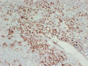 Immunohistochemical analysis of paraffin-embedded human Follicular thyroid carcinoma using Anti-Thyroid Peroxidase Antibody