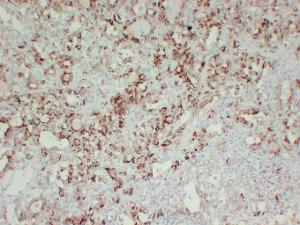 Immunohistochemical analysis of paraffin-embedded human Follicular thyroid carcinoma using Anti-Thyroid Peroxidase Antibody