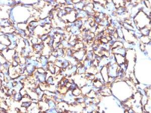 Immunohistochemical analysis of formalin-fixed, paraffin-embedded human angiosarcoma using Anti-Podocalyxin Antibody [3D3]